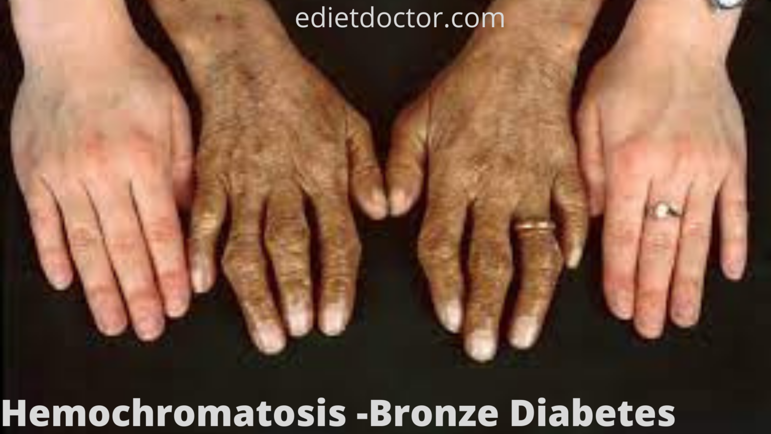 Bronze Diabetes Treatment & Prevention